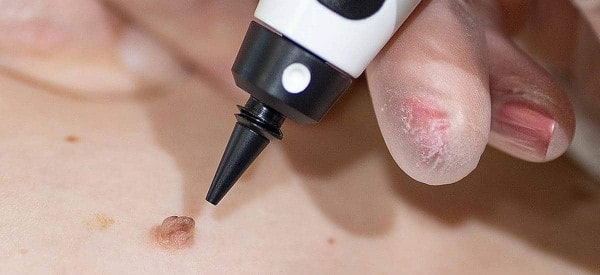 After Skin Tag Removal Ruislip Gardens