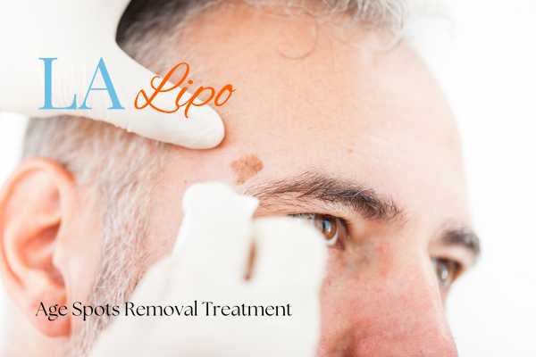 What Are the Most Effective Treatments for Age Spots Ruislip Gardens?