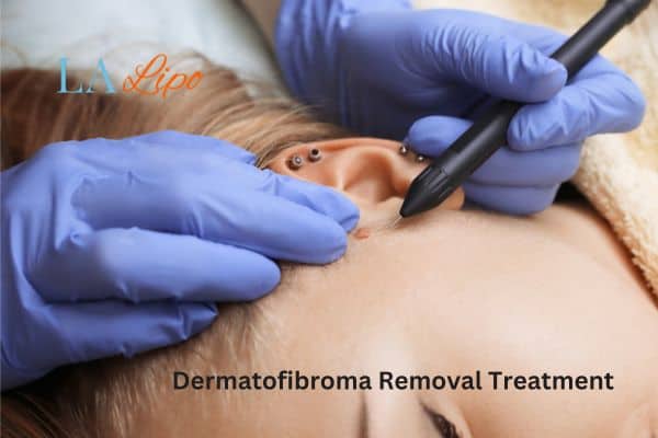 Dermatofibroma Removal Treatment Ruislip Gardens