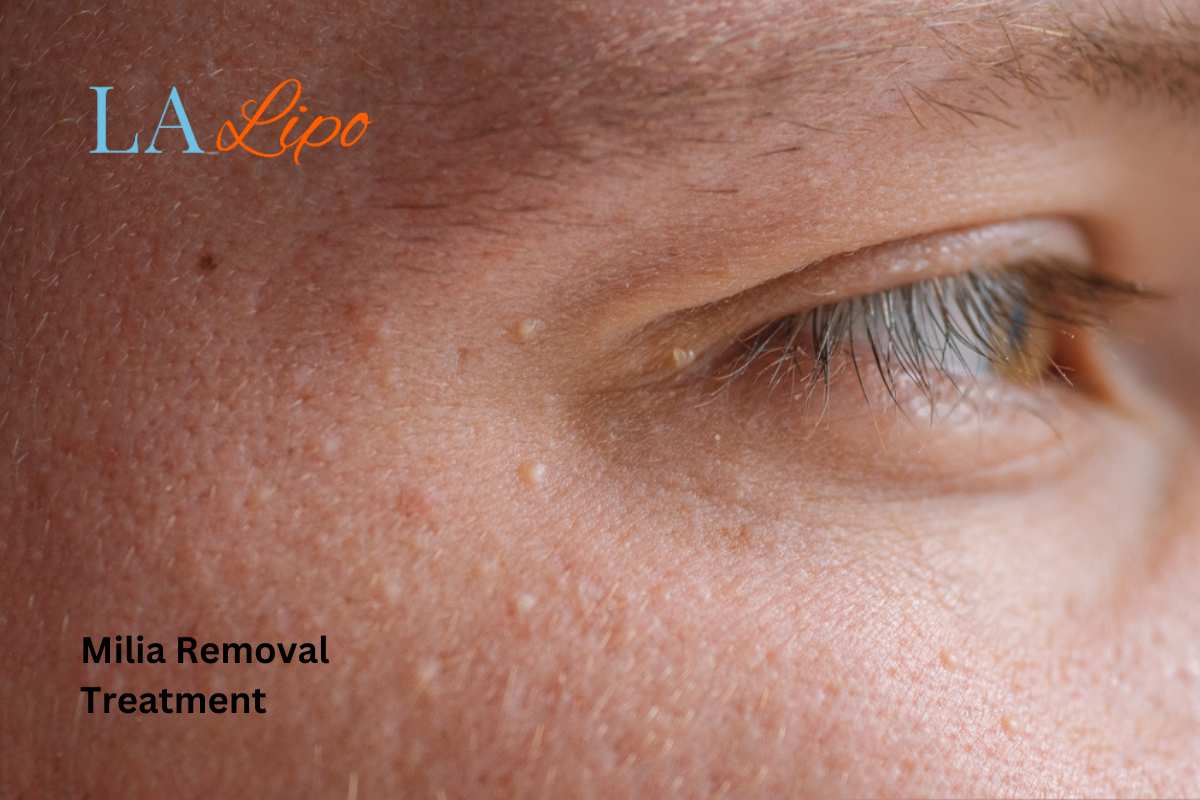 Cryopen Milia Removal: Is It the Easiest and Safest Option Ruislip Gardens?