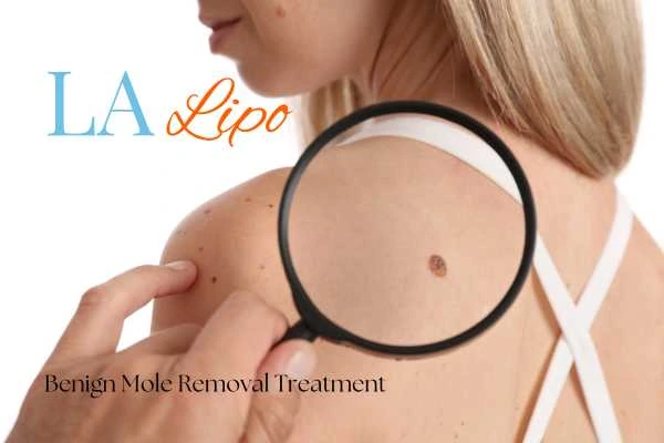 Why getting moles removed Ruislip Gardens can boost your confidence!
