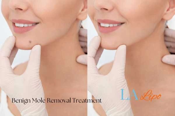 woman's before and after mole removal Ruislip Gardens results