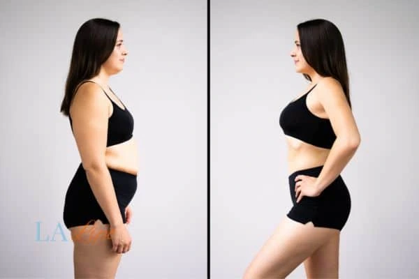 image of woman before and after results of LA-EMS Body Sculpting Ruislip Gardens to help treat Diastasis recti