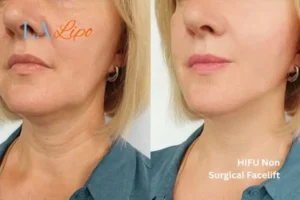 hi-fu for wrinkles Ruislip Gardens before and after results