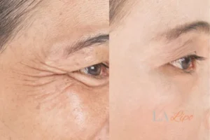 Before and after results of woman - HI-fu wrinkles reduction treatment Ruislip Gardens