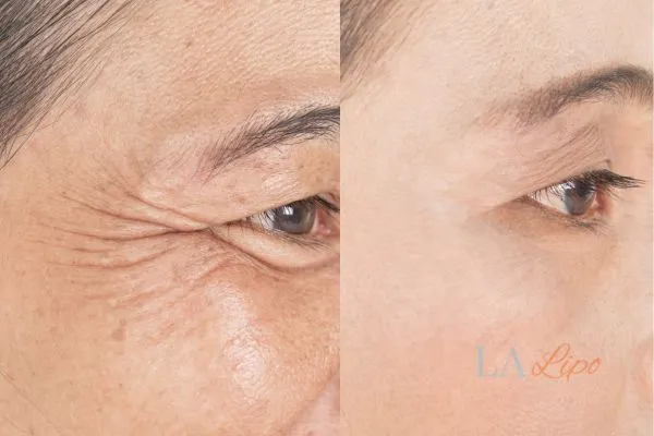 Before and after results of woman - HI-fu wrinkles reduction treatment Ruislip Gardens