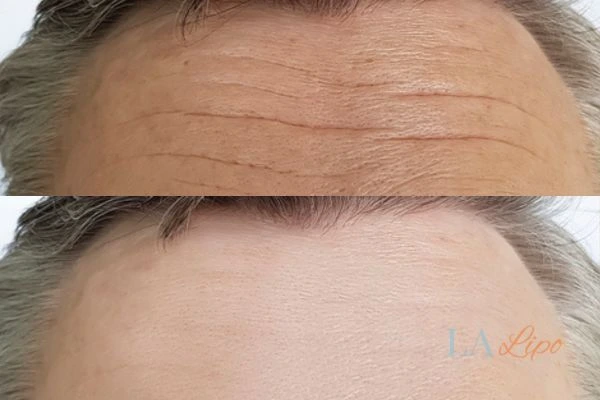results of HIFU Ruislip Gardens on mans forehead to help reduce lines and wrinkles