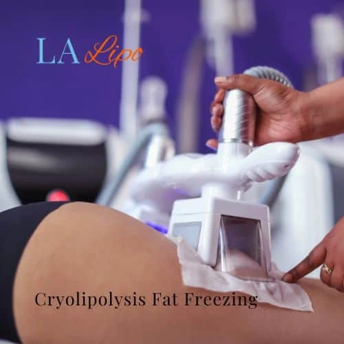 fat freezing - Cryolipolysis Ruislip Gardens