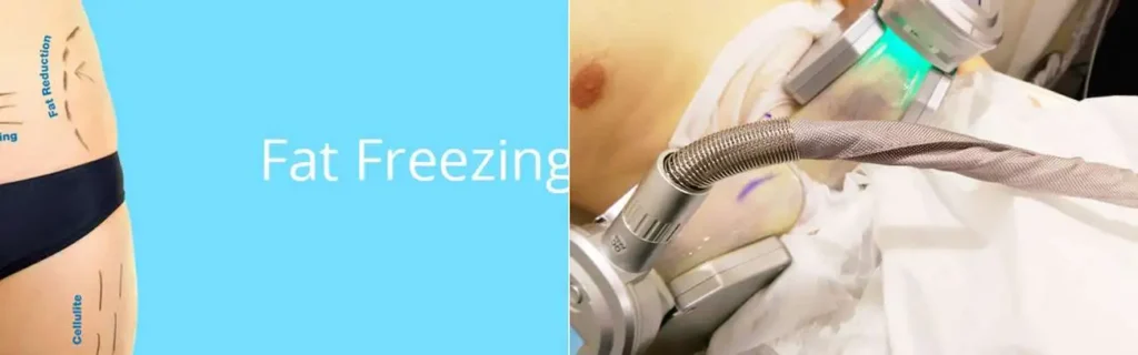 Fat freezing Ruislip Gardens on multiple areas of the body