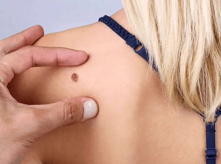 woman having mole removal Ruislip Gardens consultation before treatment.