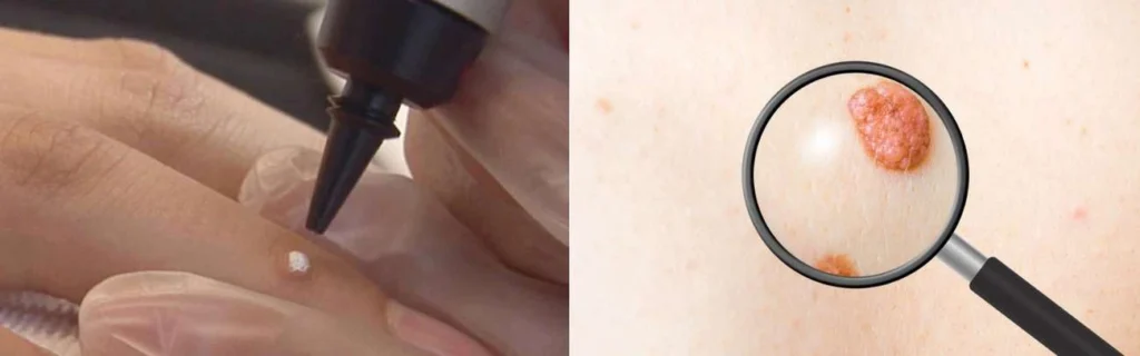 Person getting moles removed with cryopen Ruislip Gardens