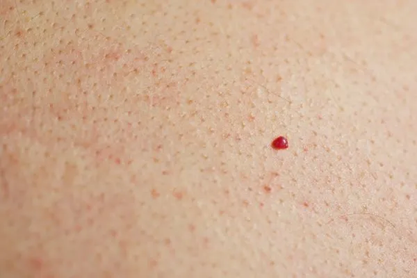 close up of a cherry angioma Ruislip Gardens