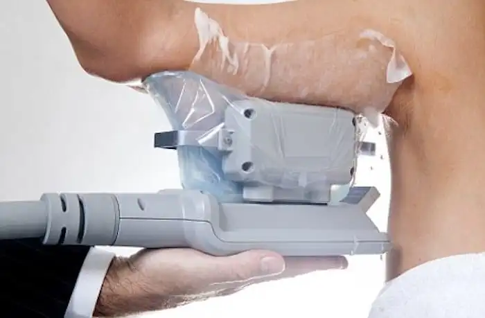 Picture of fat freezing Ruislip Gardens on the upper arms.