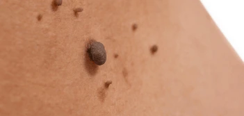 image of a skin tag Ruislip Gardens