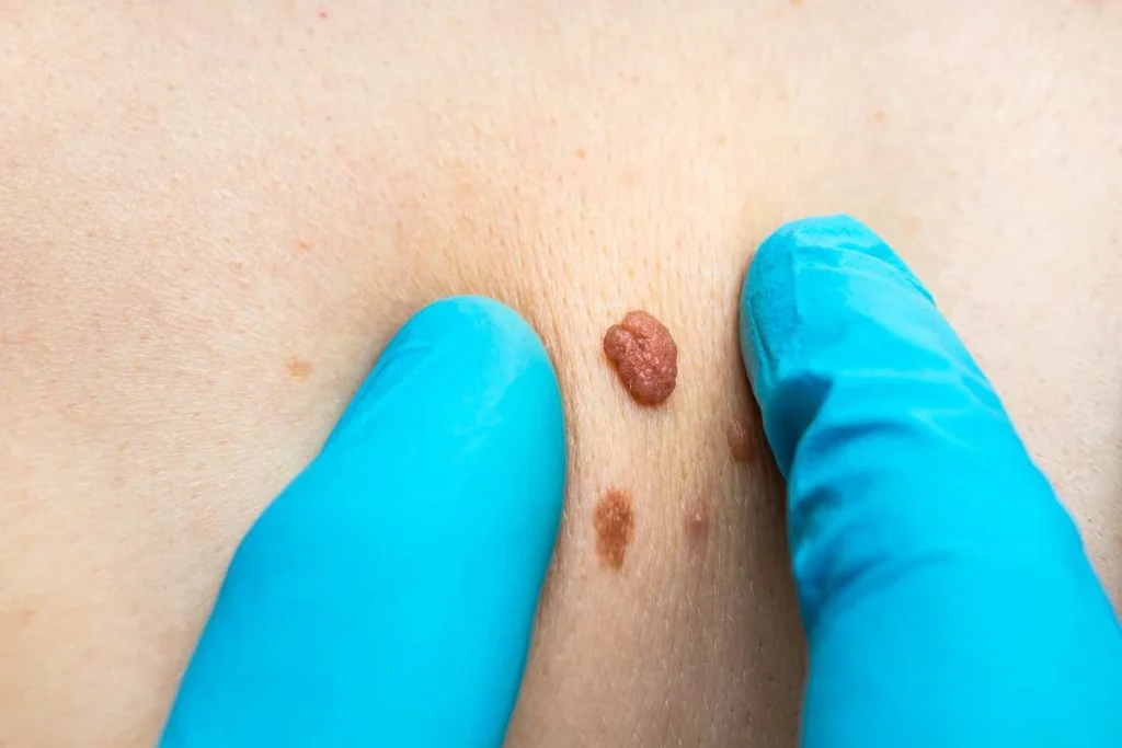 Consultant examining a skin tag Ruislip Gardens