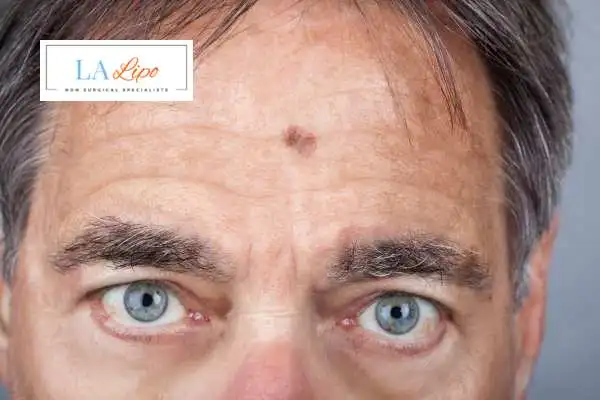 Solar Lentigo Removal Ruislip Gardens image of man with mark on his forehead