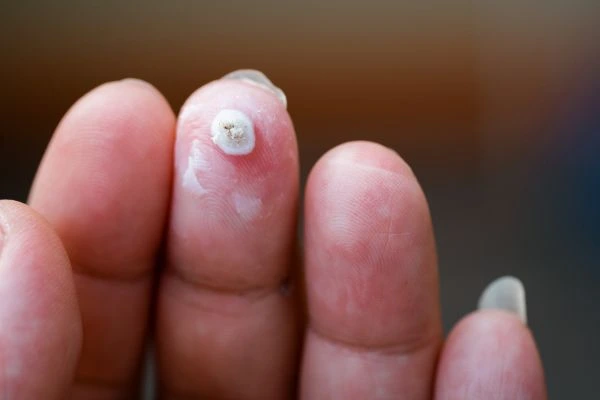 wart on person finger - cryotherapy to treat from LA LIPO Ruislip Gardens