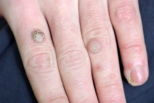 photo of warts on person hand - see wart removal Ruislip Gardens from LA LIPO