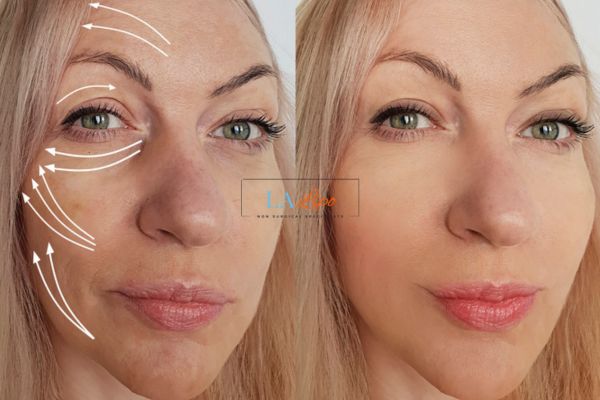 Morpheus 8 results Ruislip Gardens face lift.