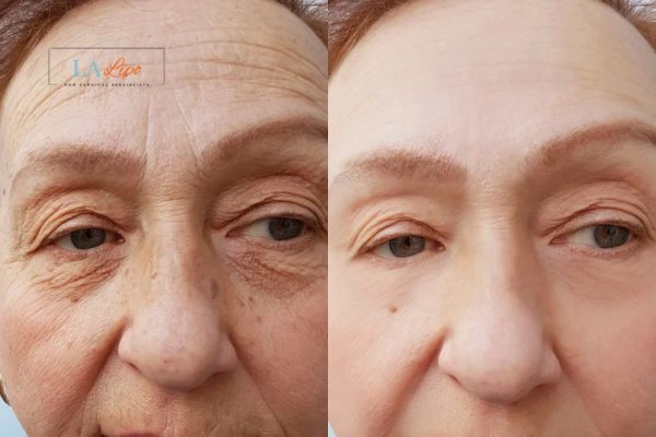 The powerful benefits of Morpheus8 Treatment Ruislip Gardens - Call Our team today!
