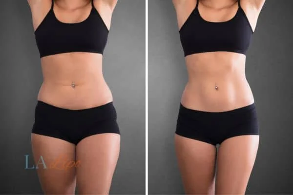 before and after results of non-surgical treatment to help a woman's body image and mental health Ruislip Gardens