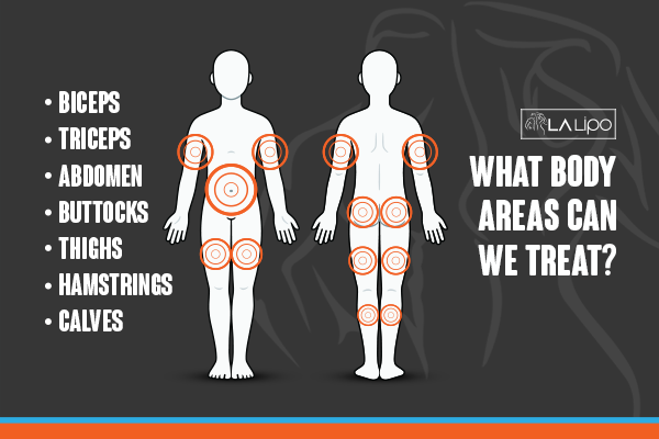 Diagram to show areas you can have LA-EMS Body Sculpting Treatment Ruislip Gardens