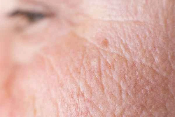 close up picture of a woman's face showing an age spot Ruislip Gardens
