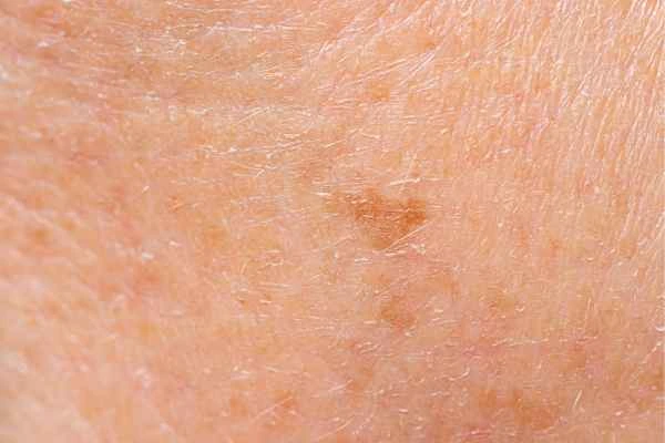 close up picture of age spots Ruislip Gardens